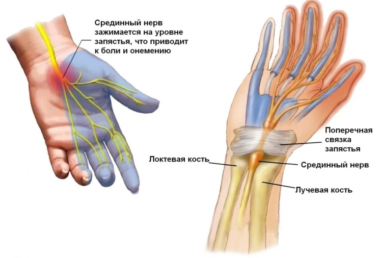 Неврит срединного нерва руки: что это такое?