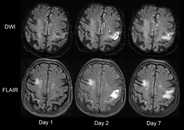 Рассеянный склероз на МРТ: как выглядит на снимке?