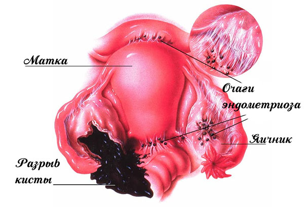 Разрыв эндометриоидной кисты 