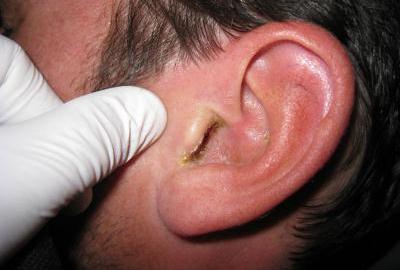 Невралгия ушного узла: дифференциальная диагностика