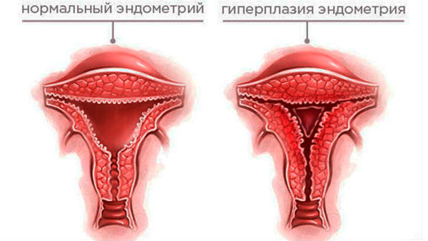 Гиперплазия эндометрия в сравнении с нормой