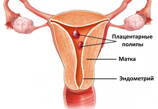 Плацентарные полипы как следствие аборта