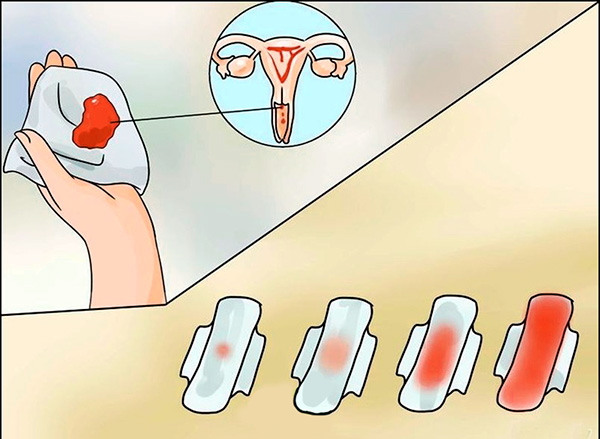 Интенсивность маточного кровотечения определяется гормональной активностью кисты