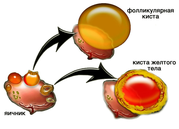 Формирование функциональных кист яичника