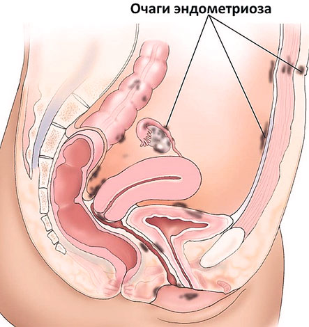 Очаги наружного эндометриоза могут распространятся за пределами репродуктивных органов