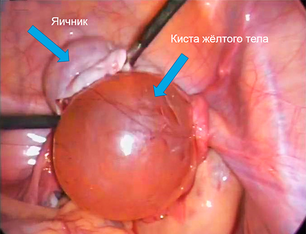 Вид лютеиновой кисты во время операции по ее удалению