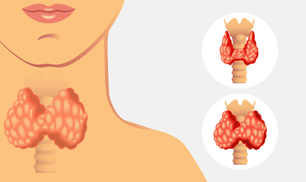 Гипофункция щитовидной железы как фактор риска для возникновения кисты