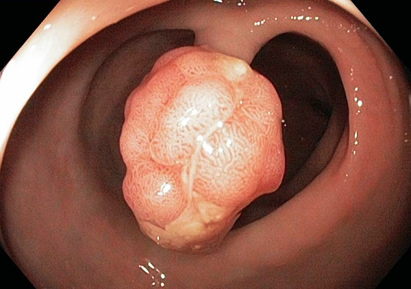 Полип эндометрия внешне может походить на субмукозный узел