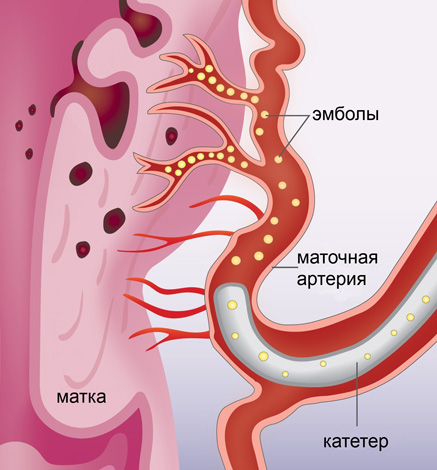 Эмболизация маточных артерий при аденомиозе