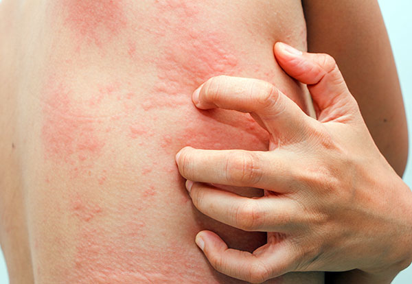 Аллергия на средства народной медицины