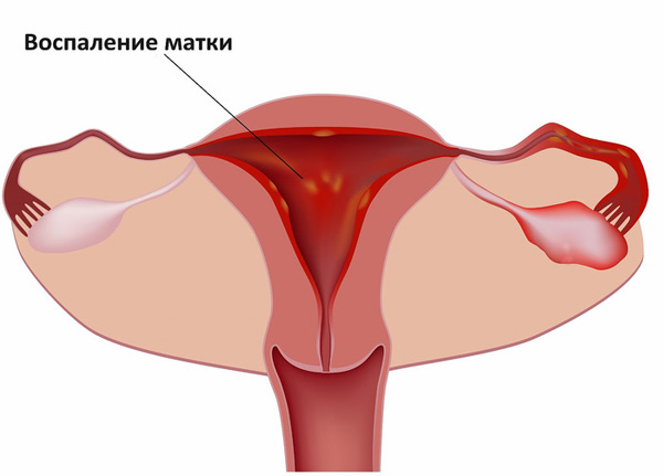 Цервицит может спровоцировать возникновение эндометрита (воспаления матки) 
