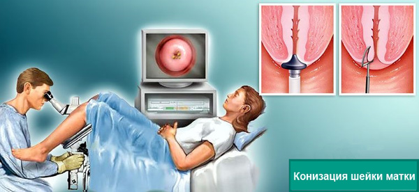 Конизация шейки матки при лечении цервикальной кисты практикуется в редких случаях