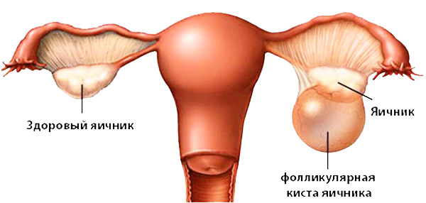 Схематичное изображение фолликулярной кисты яичника
