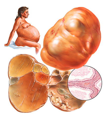 Гигантская серозная киста яичника, вид в разрезе и гистологическая структура