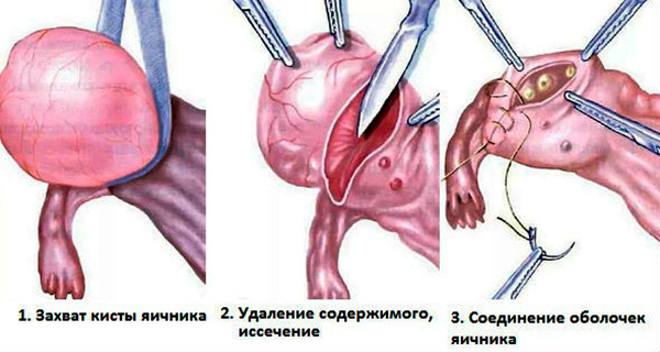 Этапы операции по удалению кисты яичника