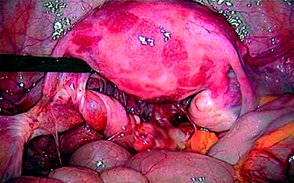 Перекрут кисты яичника - вид во время операции