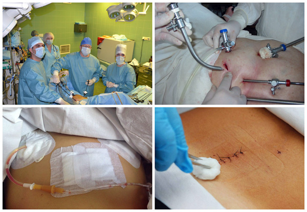 Лапароскопия кисты яичника и реабилитационный период после операции