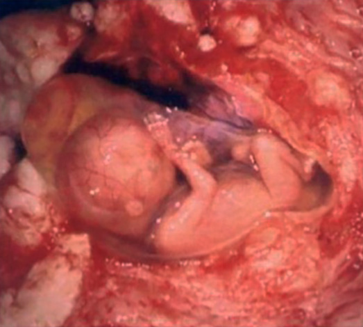 Миоматозные узлы могут затруднять развитие беременности