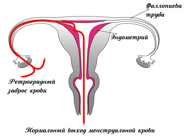 Рефлюкс менструальной крови
