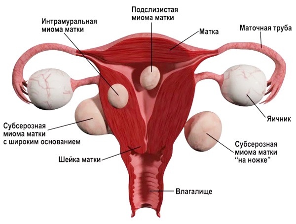 Предварительное удаление миом, которые могут помешать успешному проведению ЭКО