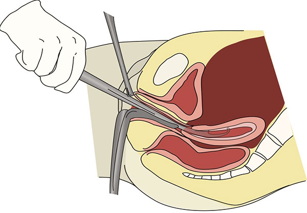 Выясняем, в каких случаях требуется выскабливание полости матки при эндометриозе и как данная процедура проходит...
