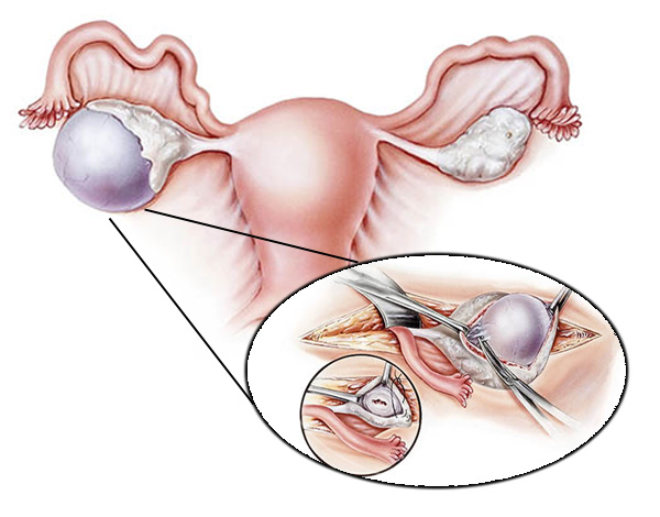 Рассмотрим, в каких случаях возможно проведение цистэктомии яичника и как проходит данная операция...