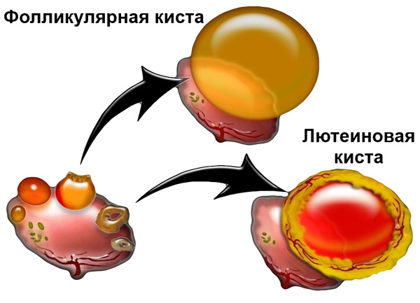 Функциональные кисты яичника
