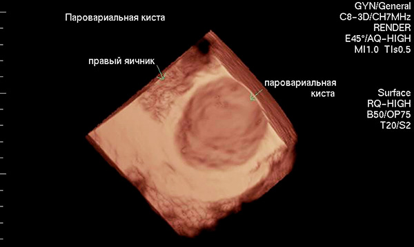 Параовариальная киста яичника на 3D УЗИ-снимке 