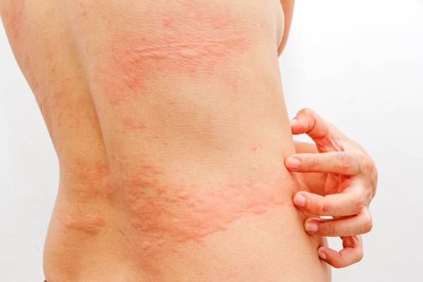 Среди побочных эффектов противовоспалительных препаратов - аллергия