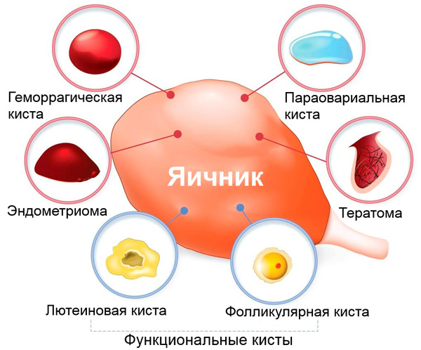 Основные виды кист яичника