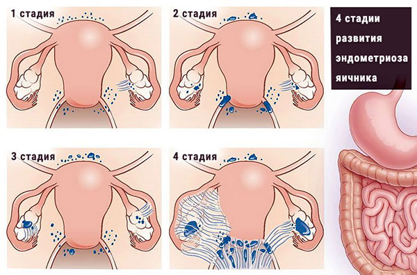 4 стадии эндометриоза яичников