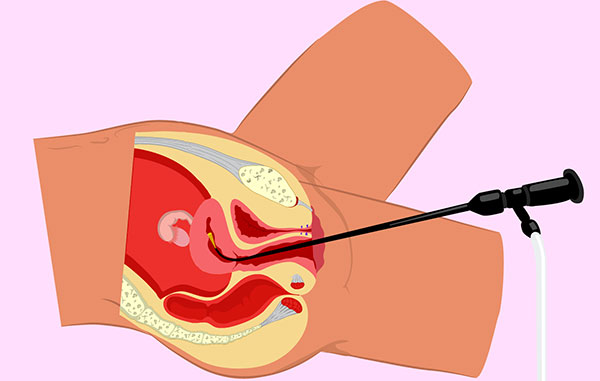Рассматриваем, как проходит процедура гистероскопии и какой эффект она дает при эндометриозе...