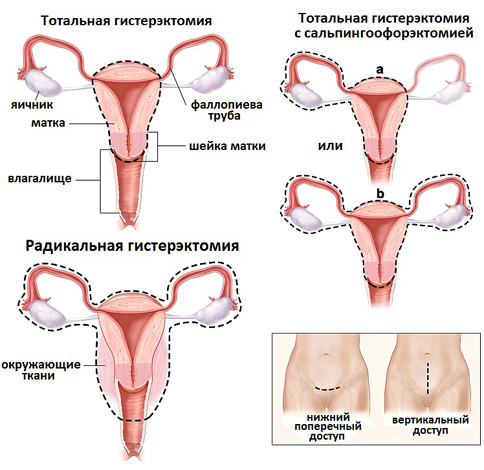 Варианты операции по удалению матки (гистерэктомия)
