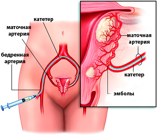 Схема эмболизации маточных артерий
