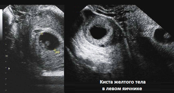 УЗИ-снимок кисты желтого тела яичника во время беременности 