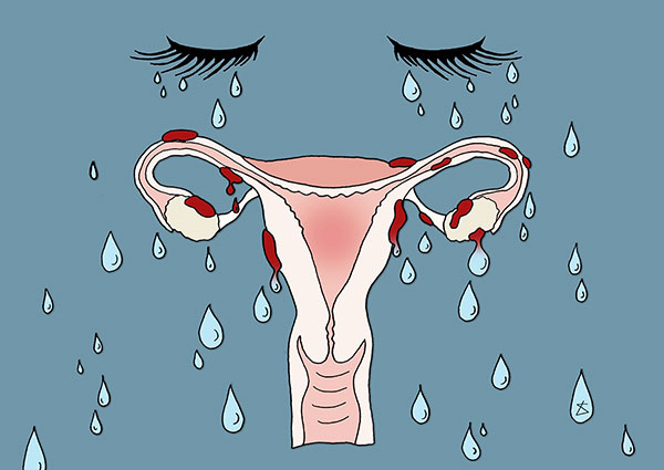 Обильные менструации при эндометриозе