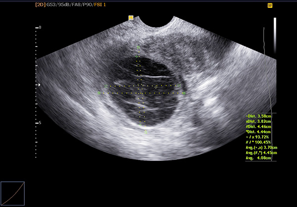 Вид нормального желтого тела яичника на УЗИ-снимке