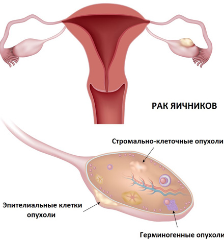 При раке яичника женщине рекомендуется половой покой