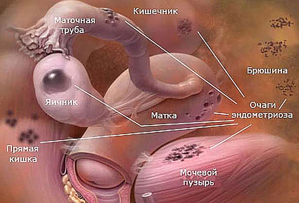 Локализация очагов эндометриоза в органах малого таза