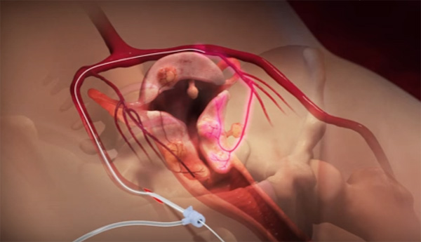 Эмболизация маточных артерий - щадящий метод лечения миомы