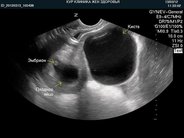 Киста и эмбрион на ранних сроках беременности (снимок УЗИ)