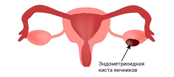 Киста яичника эндометриоидного типа