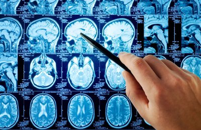 Тест на болезнь Альцгеймера: МРТ