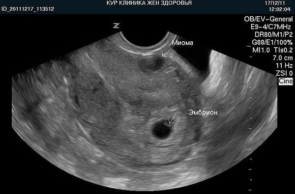 Снимок УЗИ Интрамуральной миомы и эмбриона