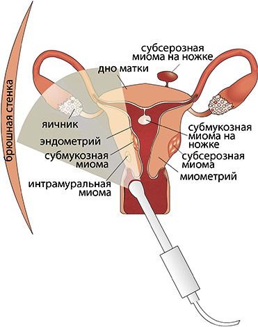 Трансвагинальное УЗИ позволяет диагностировать различные новообразования в матке и яичниках