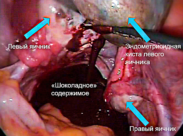 Лапароскопическая операция при разрыве кисты яичника