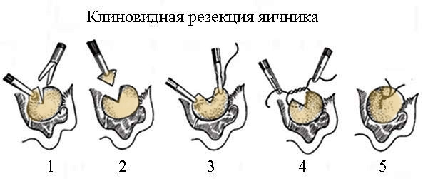 Клиновидная резекция яичника (этапы проведения)