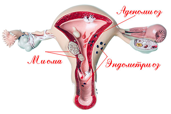 Эндометриоз в сочетании с миомой снижает шансы на беременность