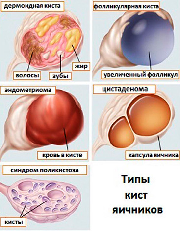 4 типа опухолевидных образований яичников