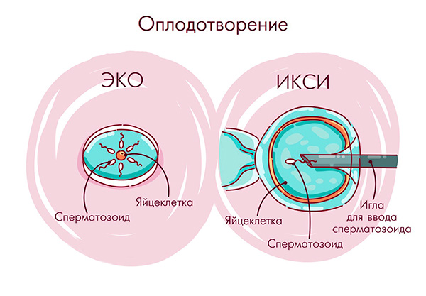 Процедуры ЭКО in vitro и ИКСИ